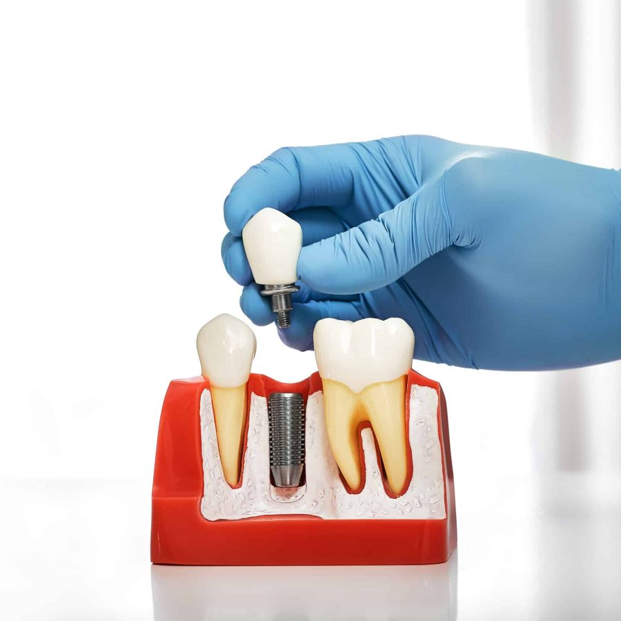 Dentist,Showing,The,Installation,Of,A,Dental,Implant,On,The